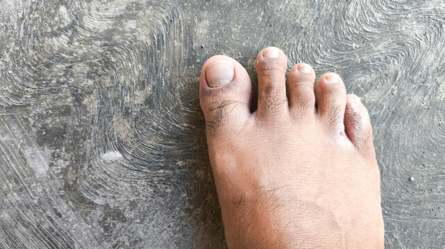 Tinea pedis on the feet that has dried up