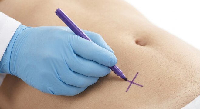 Close-up of medical professional marking the abdomen before a medical procedure.