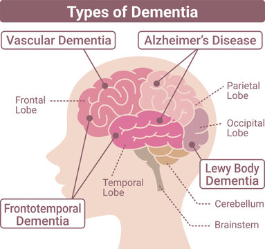 Dementia types brain diagram side view flat