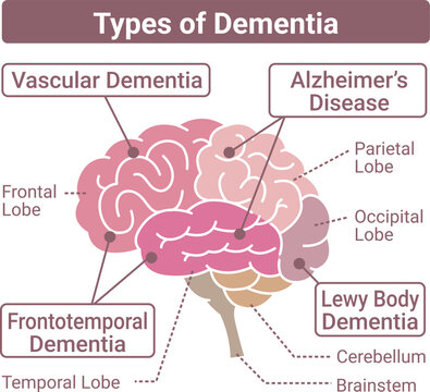 Types of dementia brain illustration flat style