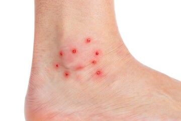 Fototapeta premium Close up of human ankle with multiple red inflamed insect bites skin