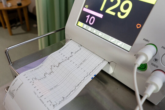 Fetal heart rate monitor machine printing results in a hospital labor room. Electronic fetal monitoring display with paper graph for prenatal care, pregnancy checkup, and maternity health.
