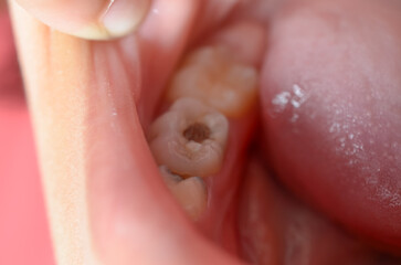 Obraz premium Close Up of Human Molars with Deep Dental Caries and Tooth Decay Needing Clinical Treatment