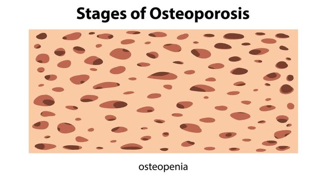 Stages of osteoporosis showing normal bone osteopenia osteoporosis and severe osteoporosis health and medical animation.