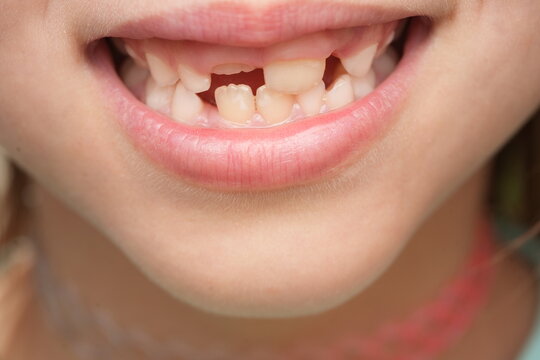 Close-up of a child's smile showing missing primary teeth and new permanent teeth coming in