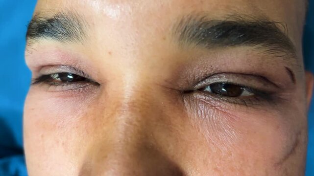 allergic reaction portrait showing inflamed facial swelling with detailed features