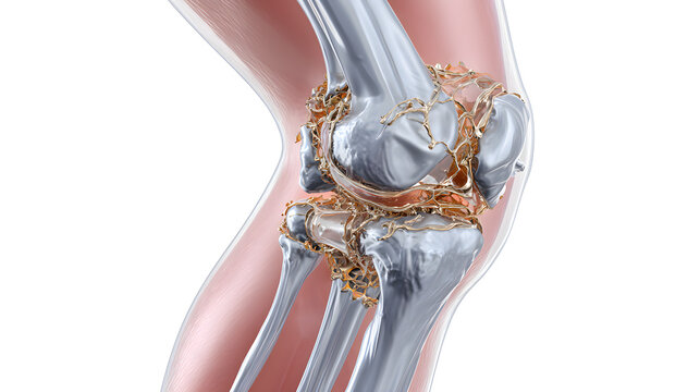 Detailed 3d illustration of a knee joint with a torn acl injury showing ligaments and bones
