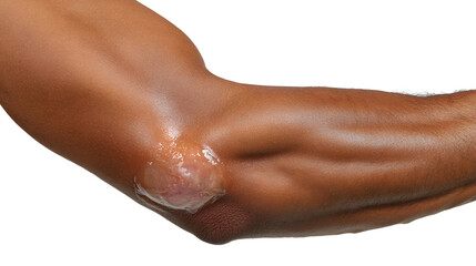 Fototapeta premium Close up of elbow bursitis on a human arm with a swollen and inflamed elbow joint
