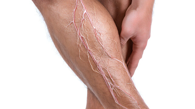 Close up of a person's leg with visible varicose veins on the popliteal area with hand touching the affected skin against a white background