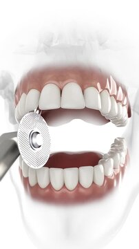 3D animation demonstrating a dental interproximal reduction (IPR) procedure using a rotating disc to create space between teeth.