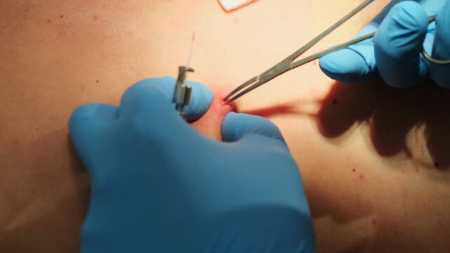 Surgeon cuts out patient mole with sterile tools in hospital slow motion. Dermatologist gives effective treatment of skin carcinoma in clinic closeup