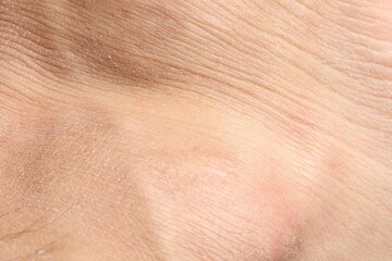 Fototapeta premium Texture of dry skin as background, closeup