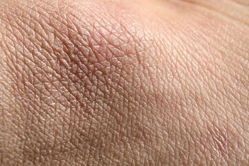 Fototapeta premium Man with dry skin on his hand, closeup