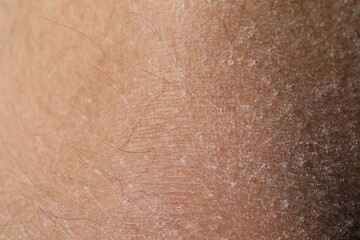 Fototapeta premium Texture of dry skin as background, closeup
