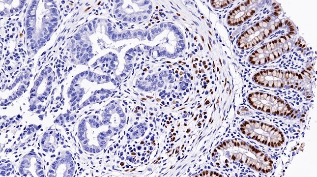Colon Cancer Microsatellite Instability MMR Protein IHC
