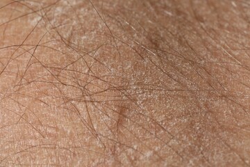Fototapeta premium Texture of dry skin as background, closeup