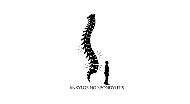 Medical illustration of Ankylosing Spondylitis with silhouette of spine and human.