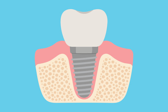 Anatomy of Dental Implant Surgery in Human Jaw Bone