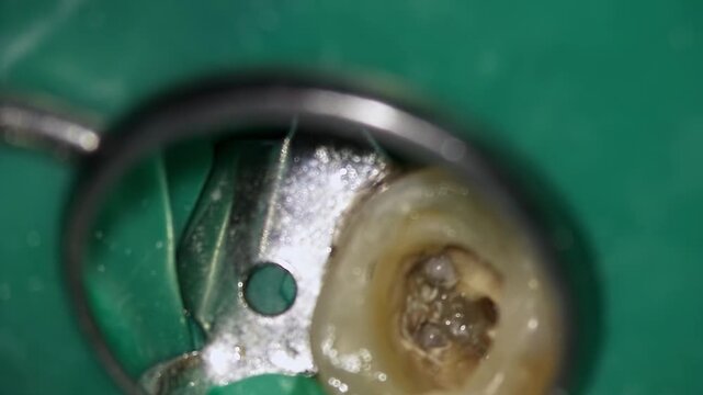 Macro molar access cavity under rubber dam showing pulp chamber and canal orifice through dental mirror, clamp visible clinical endodontic documentation capturing instrument entry and decay removal.