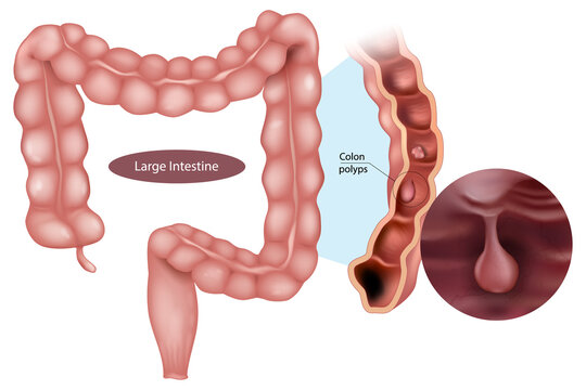 Medical illustration of the large intestine highlighting colon polyps. Anatomical structure of the colon along with a cross-sectional view and magnified close-up of a polyp inside the intestinal lumen