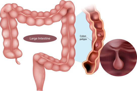 Medical illustration of the large intestine highlighting colon polyps. Anatomical structure of the colon along with a cross-sectional view and magnified close-up of a polyp inside the intestinal lumen