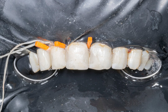 Intraoral view of maxillary incisors isolated by a black rubber dam during restoration. Metallic clamps and orange wooden wedges are placed approximately to stabilize and ensure proper adaptation.