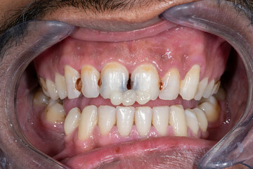 Front view of an esthetic dentistry case featuring interproximal carious lesions on maxillary incisors and canine. Resin composite pellet samples are placed for precise color matching and shade select © MSC