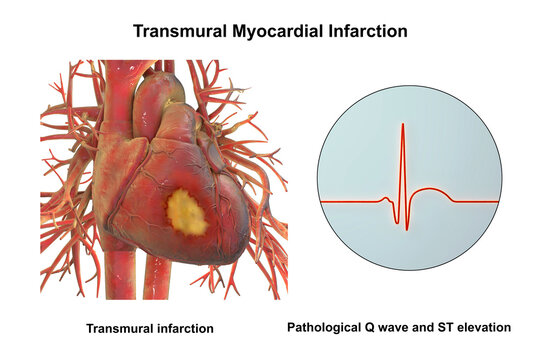 Transmural myocardial infarction with ventricular wall necrosis, combined with ECG showing pathological Q waves and ST-segment elevation, 3D illustration