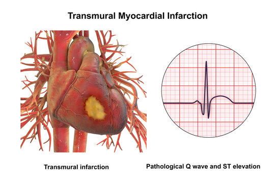 Transmural myocardial infarction with ventricular wall necrosis, combined with ECG showing pathological Q waves and ST-segment elevation, 3D illustration