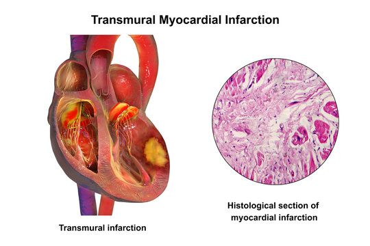 Transmural myocardial infarction with ventricular wall necrosis, 3D illustration, combined with micrograph showing cardiomyocyte necrosis, inflammatory infiltrates and fibrous scar tissue