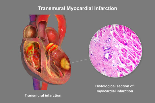 Transmural myocardial infarction with ventricular wall necrosis, 3D illustration, combined with micrograph showing cardiomyocyte necrosis, inflammatory infiltrates and fibrous scar tissue