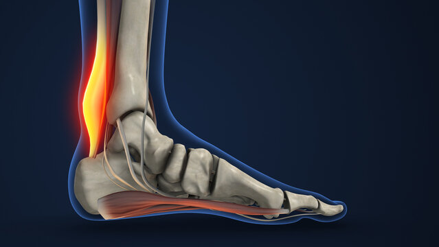 Heel Pain from Achilles Tendon Inflammation