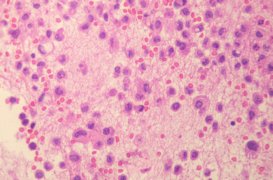Medical themes: Microscopic image of a rhabdoid sarcoma