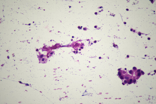 Medical themes: Microscopic image of an acinar adenocarcinoma of the lung.