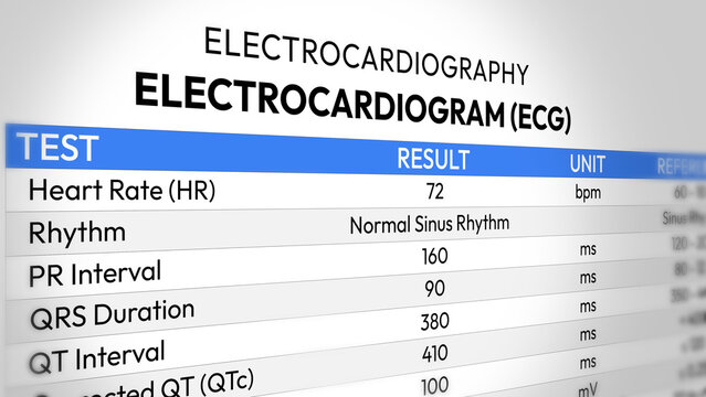 Random Ecg Sinus Rhythm Images – Browse 21,252 Stock Photos, Vectors, and Video ...