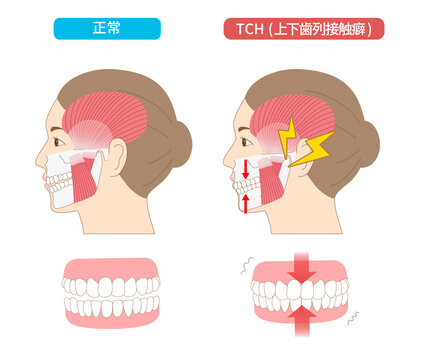 上下の歯を無意識に接触させてしまうTCH（歯列接触癖）と正常な歯との比較イラスト
