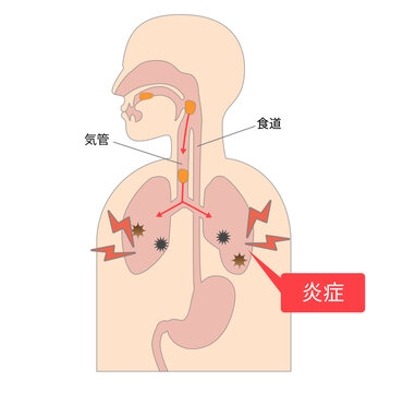 誤嚥性肺炎により食べ物が気管に入り肺で炎症を引き起こす際のメカニズム