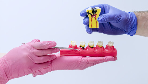 Dentists holding educational models showing external cavities and a cross-section of severe deep decay reaching the pulp. Pulpitis concept.