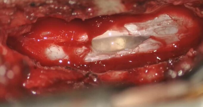 Laminectomy Spinal Epidermoid Cyst Removal Surgery Video. High angle view of neurosurgeon performing microsurgical total excision of lumbar tumor using unilateral laminoplasty technique for medical ed