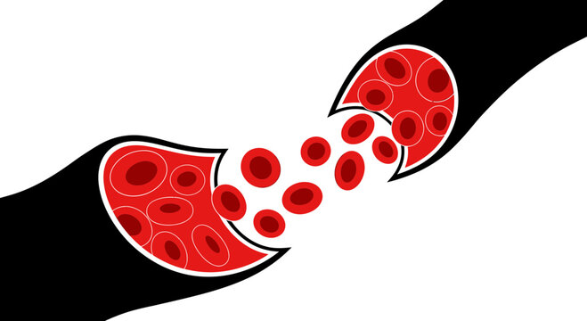 Vector illustration of red blood cells escaping a ruptured vessel