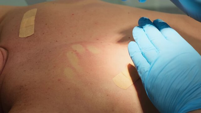 Surgeon removes moles with laser coagulation from man skin in clinic slow motion. Doctor with modern instrument treats patient birthmarks in hospital