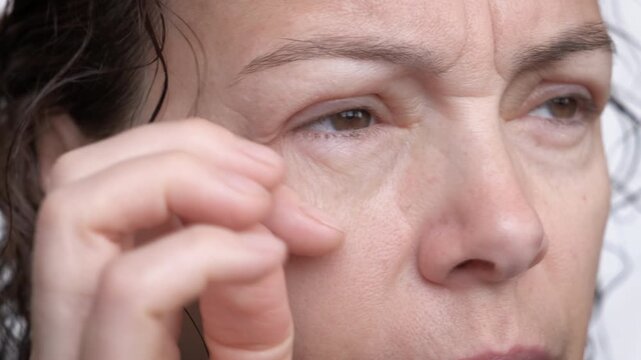 Eye swelling from mascara. A woman with allergies to mascara, with puffy eyes. Low-quality cosmetics concept
