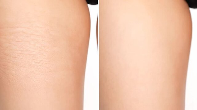 Before and After Comparison of Skin Texture Changes Highlighting Stretch Marks on Thigh for Beauty and Skincare Marketing