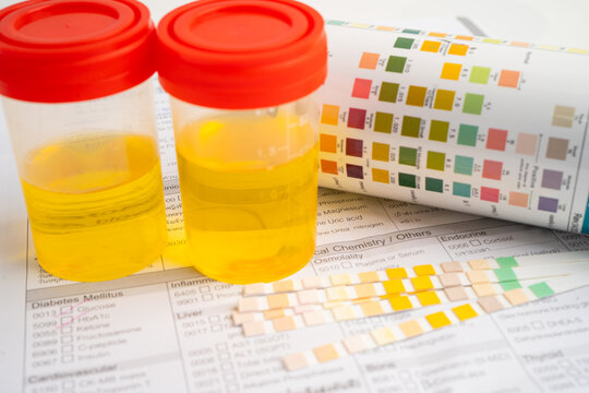 Urinalysis, urine cup with reagent strip pH paper test and comparison chart in laboratory.