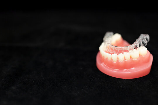 Dental aligners placement on jaw model orthodontic demonstration
