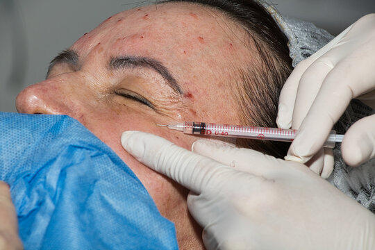 Facial rejuvenation with injections, close-up of injection from a syringe..