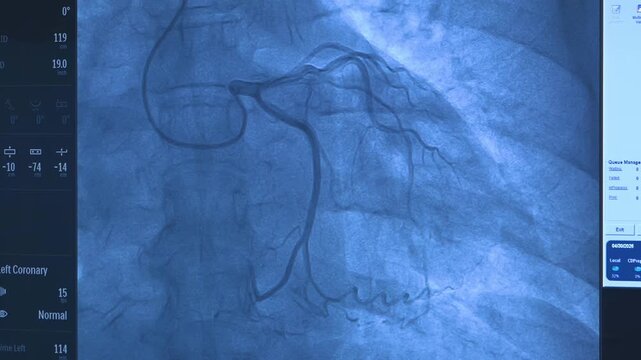 Cardiology clinic. Operating room in the cardiology department. Aortocoronary bypass surgery. This is what coronary artery bypass grafting looks like on a monitor.