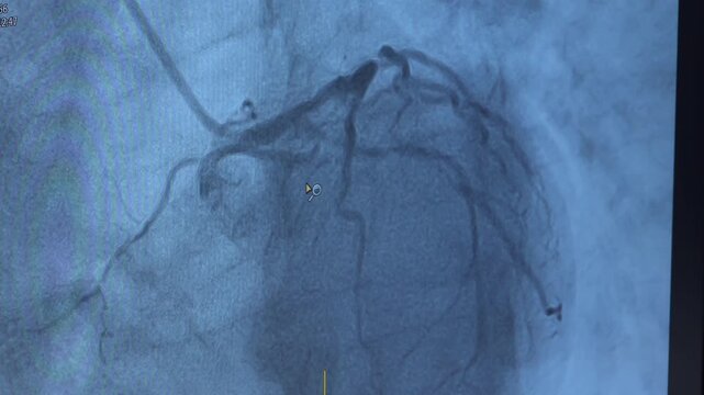 Cardiology clinic. Operating room in the cardiology department. Aortocoronary bypass surgery. This is what coronary artery bypass grafting looks like on a monitor.