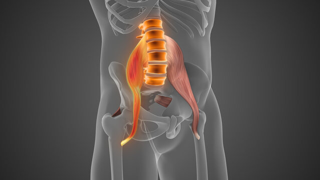 Tight Psoas Muscle Causing Lumbar Pain