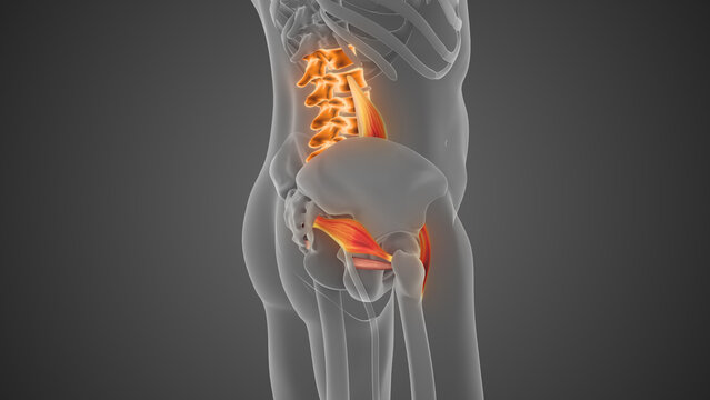Piriformis Muscle Tightness Causing Lumbar Pain